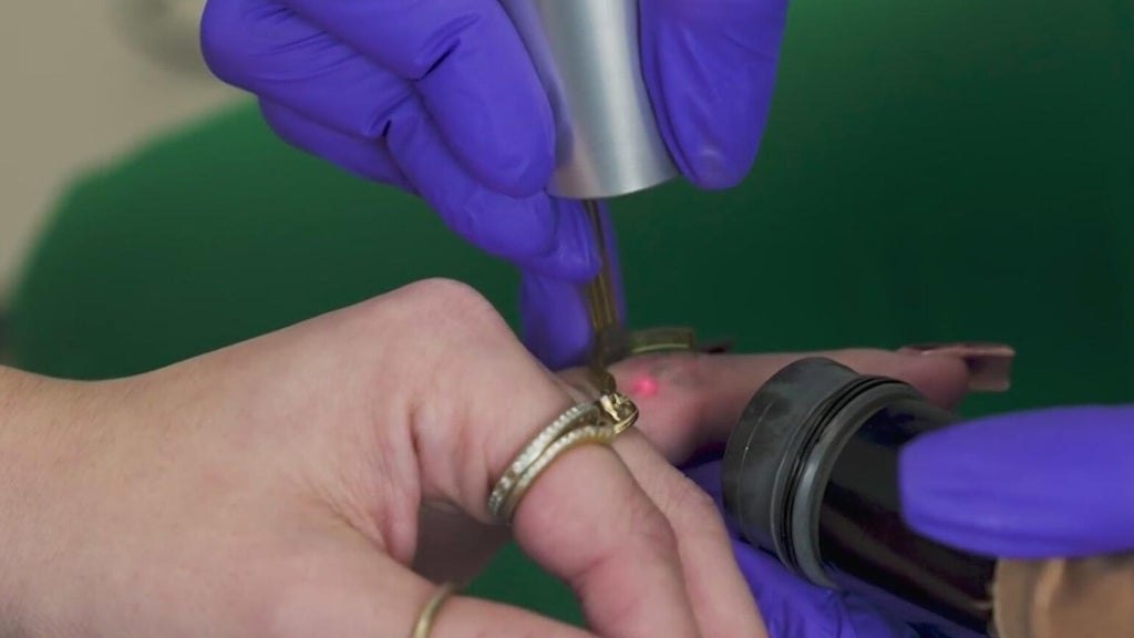 More South Florida tattoo clients are paying to get them removed — CBS Miami, Coconut Creek Health news