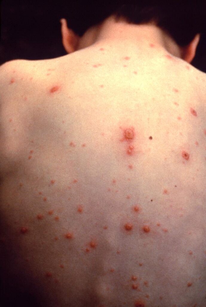 As state considers vaccine changes, new online tool examines sickness, death, cost impacts — Florida Phoenix